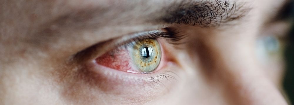Bloodshot eyes are one early sign of cocaine use that families can learn to recognize