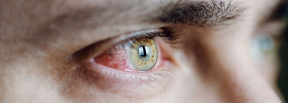 Bloodshot eyes are just one sign of cocaine abuse you can spot easily according to substance abuse treatment experts at Destination Hope in Fort Lauderdale, FL